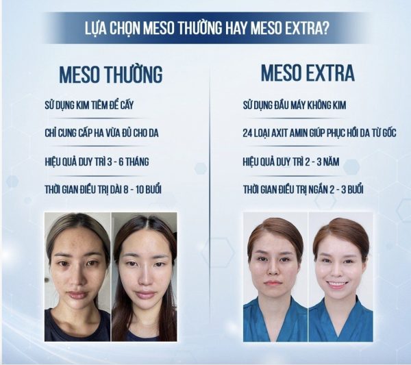 So sánh meso thường và meso extra
